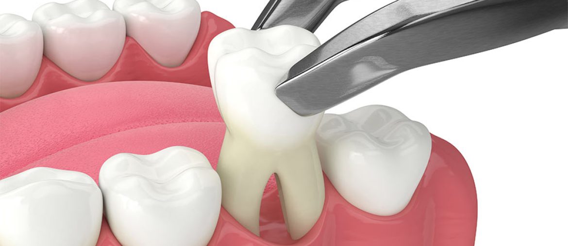 Tooth Extraction in Winter Haven, FL | Smiles of Winter Haven